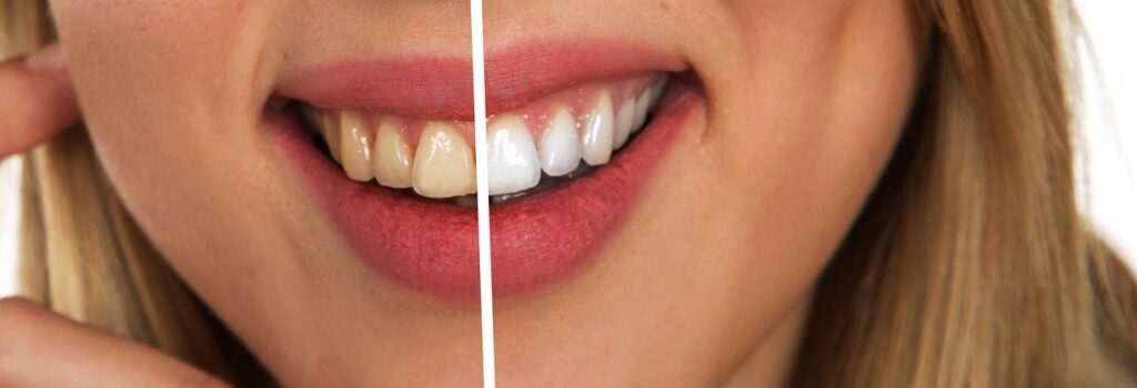 Sağlık Ajandası | Sağlık Haberleri: Diş beyazlatma yöntemleri nelerdir? 