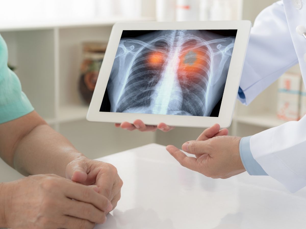 Akciğer kanseri tedavisinde yeni yöntemler